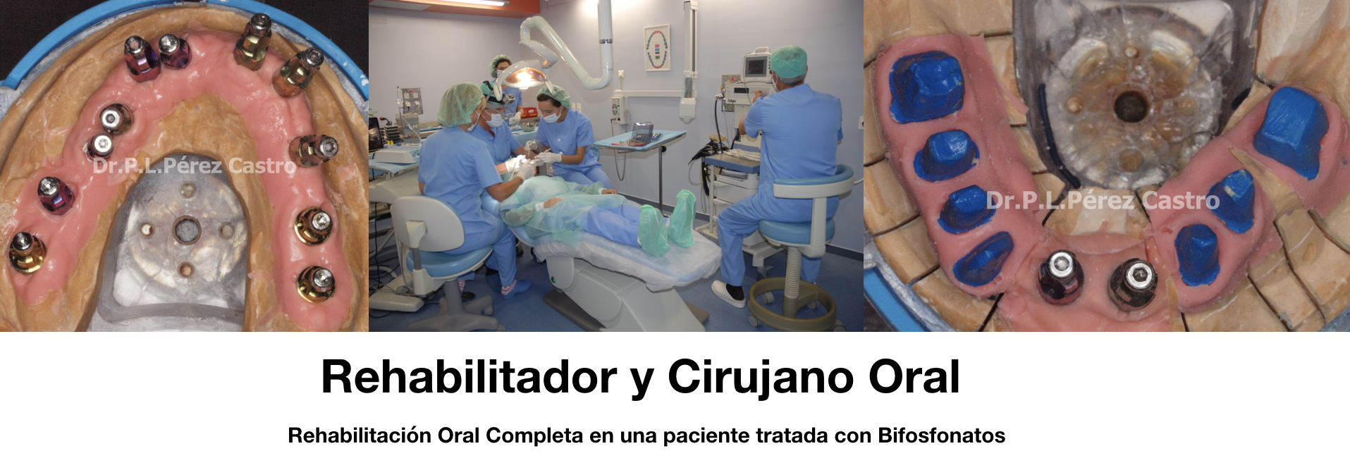 Artículo 5 – Bifosfonatos y Rehabilitación Oral 2ª Parte.