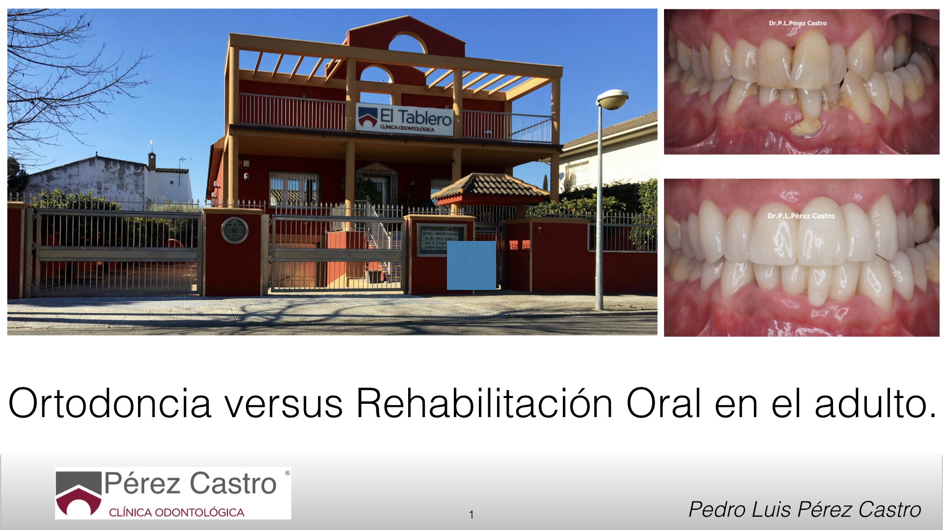 Artículo 33: Ortodoncia versus Rehabilitación Oral en adultos
