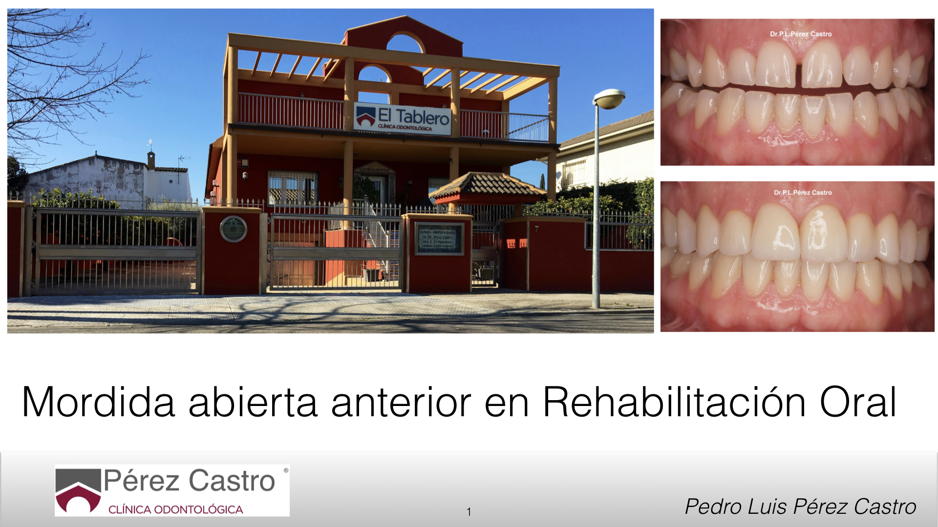 Artículo 34: Mordida Abierta en Rehabilitación Oral.