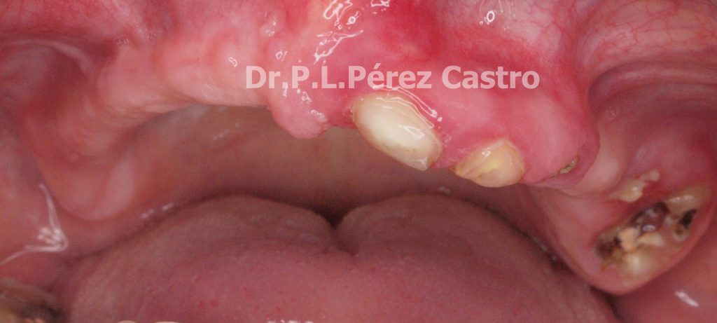 Rehabilitación Oral Completa: Dr. Pedro Luis Pérez Castro.
