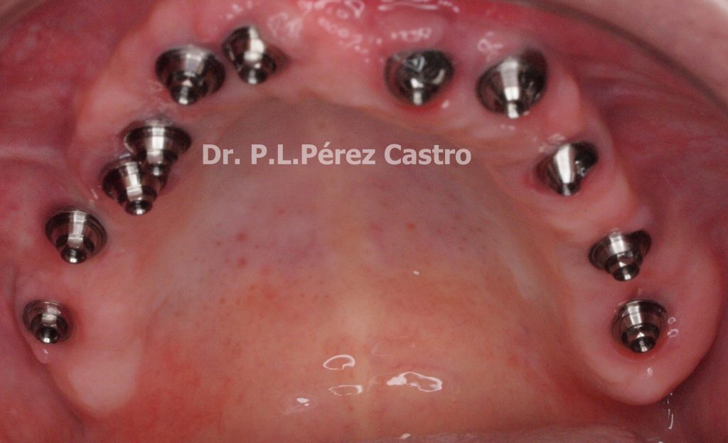 Implantes y Dimensión Vertical Dr. Pedro Luis Pérez Castro