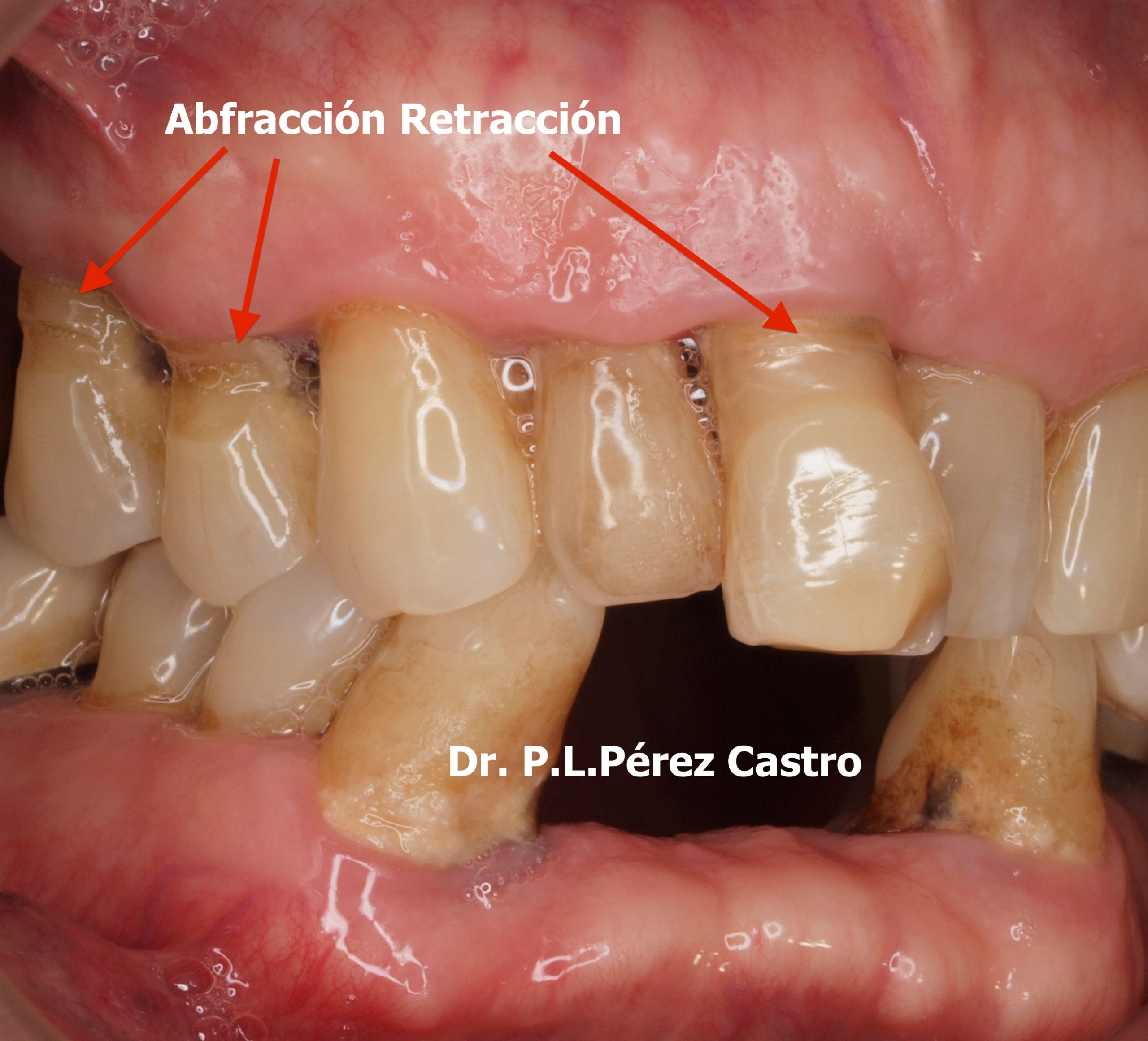 Bruxismo: ¿cómo afecta a los dientes y qué solución tiene? - Doctor Toledo