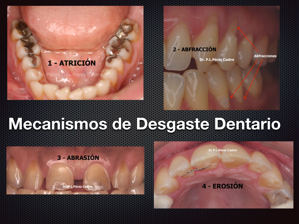 Desgaste Dentario. Dr. Pedro Luis Pérez Castro.