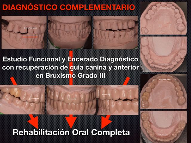 Diagnóstico Funcional en Bruxismo. Dr. Pedro Luis Pérez Castro.