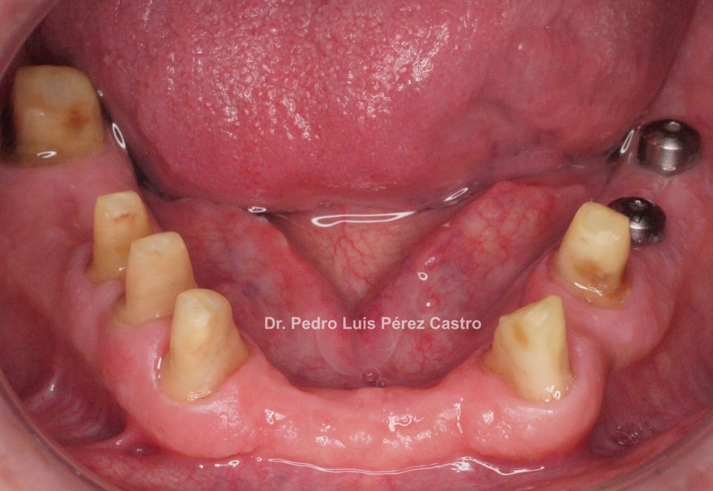 Implantes o dientes 1ª Parte Dr. Pedro Luis Pérez Castro