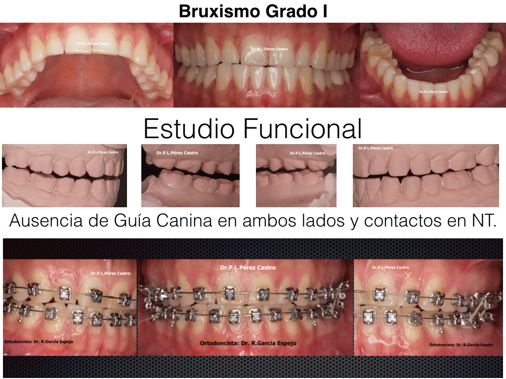 Tratamiento del Bruxismo Grado I Dr. Pedro Luis Pérez Castro