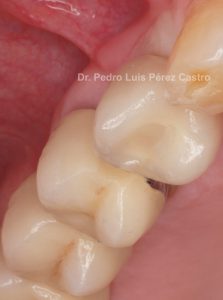 Implantes o dientes 2ªParte Dr. Pedro Luis Pérez Castro.