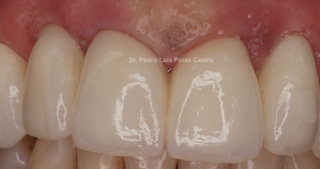 Implantes o dientes 2ªParte Dr. Pedro Luis Pérez Castro.