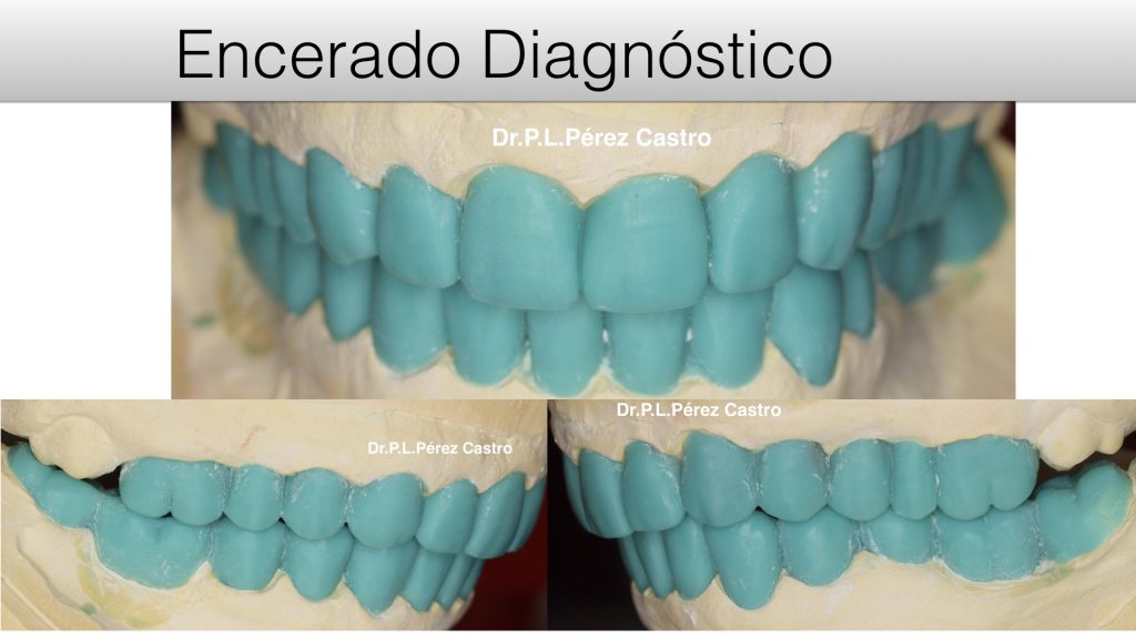 Clínica dental Dr. Pérez Castro en Córdoba, Encerado Diagnóstico.