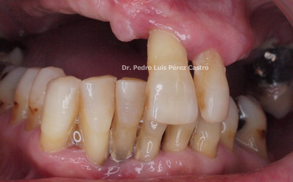 Bifosfonatos y osteonecrosis de los maxilares  Dr. Pedro Luis Pérez Castro