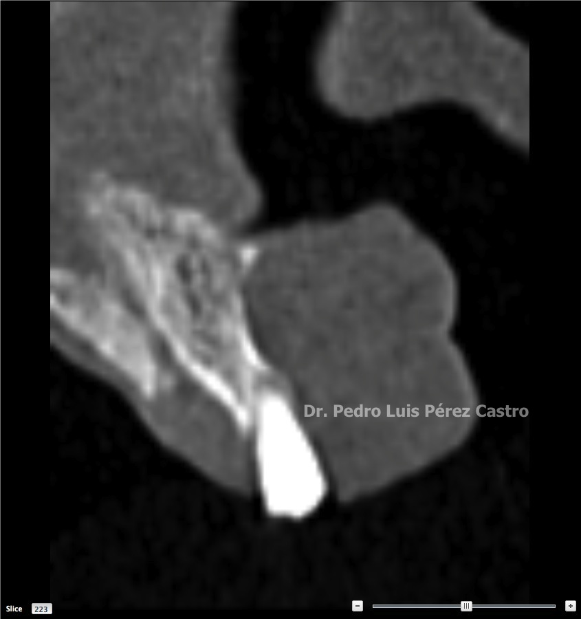 Bifosfonatos y osteonecrosis de los maxilares  Dr. Pedro Luis Pérez Castro
