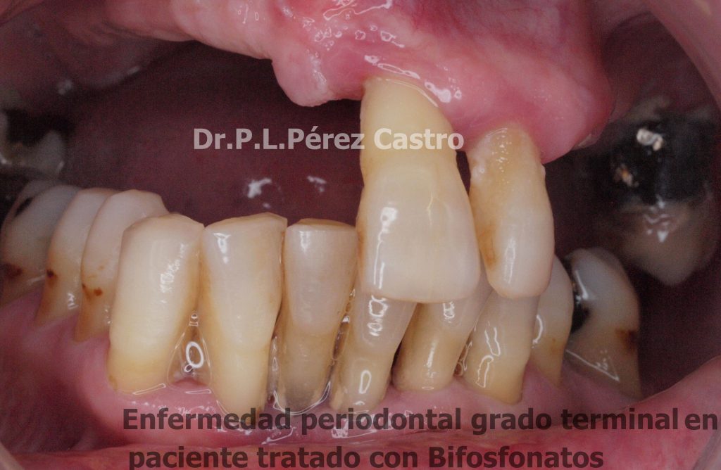 Bifosfonatos y Osteonecrosis en Rehabilitación Oral Dr. Pedro Luis Pérez Castro