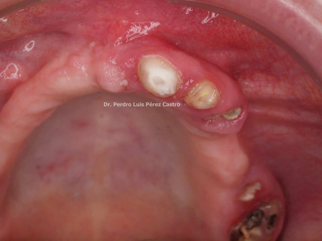 Bifosfonatos y Osteonecrosis en Rehabilitación Oral Dr. Pedro Luis Pérez Castro